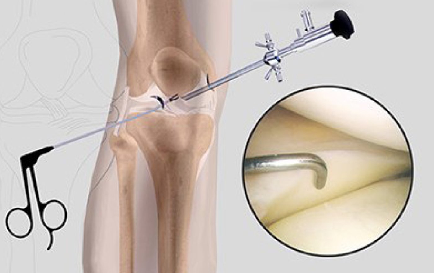 During the arthroscopy procedure